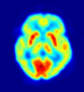image de cerveau obtenue avec la technique de tomograpahie